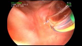 Biliary Manometry  Sphincter of Oddi [upl. by Orat]