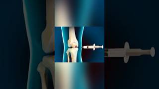 KNEE JOINT INJECTION  intraarticular injectionomkarclinic12369 [upl. by Sirob]