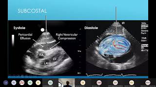 21 04 13 Pericardiocentesis lecture [upl. by Howie]