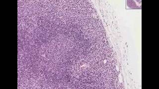 Histopathology Lymph nodeNodal marginal zone Bcell lympho [upl. by Mimajneb254]