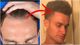 Do Hair Transplants last forever ft Defeating Hairloss [upl. by Eldwen266]