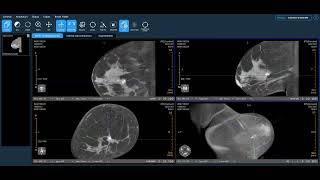 Koning Health Clinical Review Ductal Carcinoma in Situ Calcifications [upl. by Elpmid704]