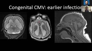 Congenital and Perinatal CNS Infections  Dr Yi Li  5162024 [upl. by Egwan69]