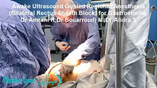 Awake Ultrasound Guided Regional Anesthesia Bilateral Rectus Sheath Block for Gastrostomie [upl. by Natalee]