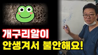 모발이식 성공의 지표는 개구리알 [upl. by Gwenn]