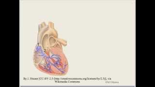 Arrhythmia Bradycardia [upl. by Einwahs]