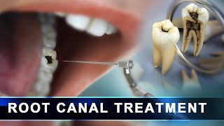 Root Canal Treatment step by step  Curveia Dental Animation in 3D  Endodontics for tooth decay [upl. by Cheffetz]