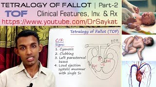 Tetralogy of Fallot TOF  Part 2  Clinical features Investigations amp Treatment  Dr Saykat [upl. by Ardeth]