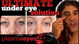 THE ULTIMATE UNDER EYE TREATMENT  PlasmaEyes [upl. by Reivaj]