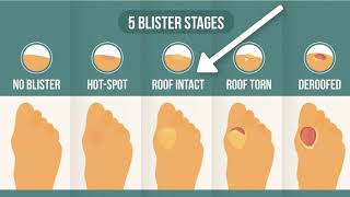 How To Treat A Blister Correctly First Look At Your Blister Roof [upl. by Jessamine277]