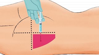 Como Aplicar Inyección Intramuscular en el GLUTEO 🍑 [upl. by Oidgime]