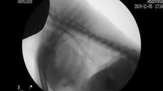 esophagography 7 days after proximal gastrectomy [upl. by Boar130]