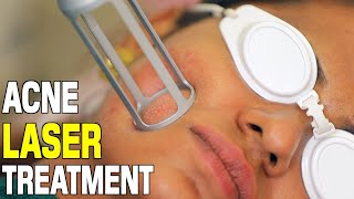 Acne Laser Treatment  CO2 Laser Treatment For Acne Scars  Dr Priya Prabakar Medical Cosmetologist [upl. by Animehliw126]