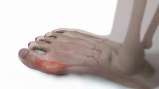 5 Secret Tricks to Treat Bunion Pain in Big Toe Without Surgery [upl. by Regni345]