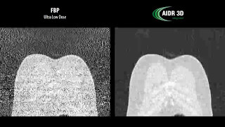 AIDR 3D Enhanced Integrated Ultra Low Dose Chest [upl. by Cockburn133]