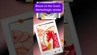 Hemorrhagic stroke occurs when a blood vessel in the brain ruptures Stroke EmergencyResponse [upl. by Champagne]