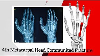 4TH METACARPAL HEAD COMMUNITED FRACTURE CRIF WITH MULTIPLE 12 K WIRES USING BOUQUET TECHNIQUE [upl. by Ainecey656]