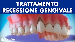 Gengive ritirate  Trattamento recessione gengivale © [upl. by Anhsirk505]