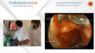 Hemostase endoscopique dun ulcère duodénal hémorragique [upl. by Atiuqan241]