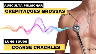 CREPITAÇÕES GROSSAS AUSCULTA PULMONAR  Crackles Coarse Lung Sounds [upl. by Leod345]