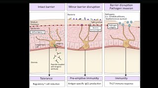 Mystery diagnosis Langerhans cell histiocytosis [upl. by Rashida]