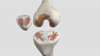 Total Knee Replacement Patient Animation [upl. by Atiuqal]