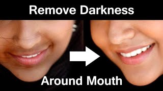 How to remove dark black patchesHyperpigmentation dark spots around your mouth  Jiya’zzz JD [upl. by Luciana]