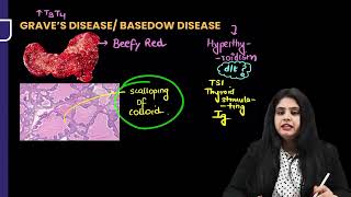 Endocrine Pathology revision by dr Preeti Sharma [upl. by Merras485]