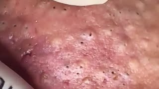 Blackheads amp Whiteheads Satisfying Removal 0275 [upl. by Marfe]