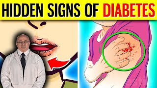 Everything about Diabetes Hidden Diabetes Symptoms [upl. by Zobe]