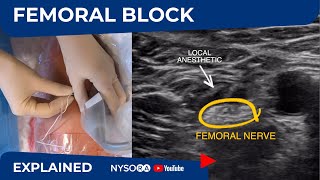 UltrasoundGuided Femoral Nerve Block  Regional anesthesia Crash course with Dr Hadzic [upl. by Desai]