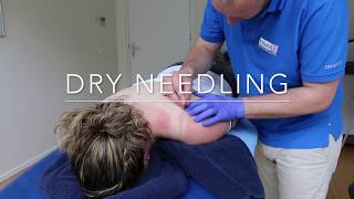 Dry Needling bij Fitaal Fysiotherapie Heerenveen [upl. by Eramat961]