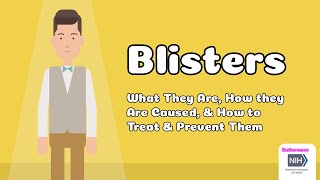 Blisters  What They Are How they Are Caused amp How to Treat amp Prevent Them [upl. by Atter]