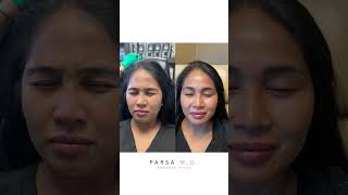 Xeomin Results for Crows Feet 11 Lines and Forehead  Dr Kami Parsa [upl. by Loise]