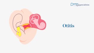 Infección en el oído Otitis  Doctores Especialistas [upl. by Lemahs776]