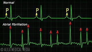 Atrial Fibrillation Anatomy ECG and Stroke Animation [upl. by Yorled45]