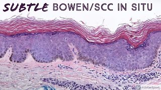 Subtle squamous cell carcinoma in situ Bowen disease  Large cell acanthoma [upl. by Aehc]