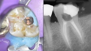 LIVE Molar Root Canal w Hyperemic Pulp  Distal Caries Molar Access FULL LENGTH [upl. by Auqinihs924]