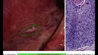 GI Disorders  Premalignant Lesions of Oral Cavity [upl. by Karr]