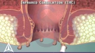 Anal warts amp infrared coagulation treatment  3D animation [upl. by Camus929]