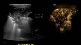 Consolidation vs Pleural Effusion [upl. by Jacobine319]