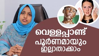 വെള്ളപ്പാണ്ട് പൂർണമായും ഇല്ലാതാക്കാം  Malayalam Health Tips  Vitiligo treatment in kerala [upl. by Sorcha405]