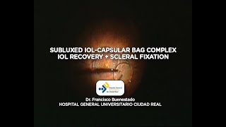 Subluxed IOLcapsular bag complex [upl. by Natsrik649]