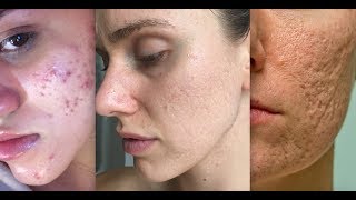 Types Of Acne Scars [upl. by China]