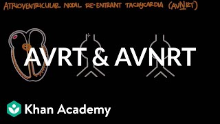 Atrioventricular reentrant tachycardia AVRT amp AV nodal reentrant tachycardia AVNRT [upl. by Roice765]