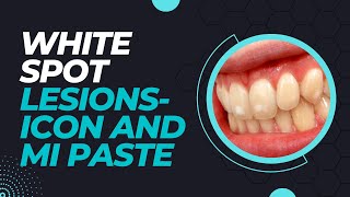 White Spot Lesions Icon and MI Paste [upl. by Gnuy853]