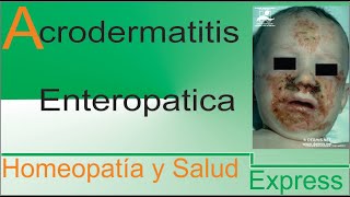 Acrodermatitis enteropatica tratamiento Homeopático [upl. by Taryne]