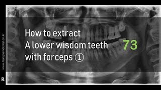 Extraction of lower wisdom tooth with forceps [upl. by Aliahs562]