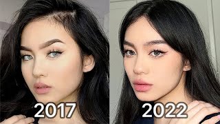 How I Changed My Face lip injections amp botox after 5 years [upl. by Forster]