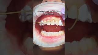 Veneer impression prep veneers dentalcord dentistry [upl. by Fishback219]